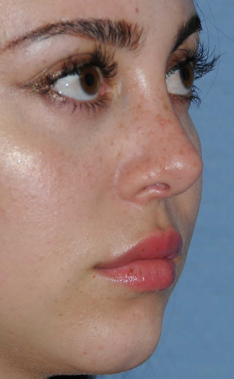 Rhinoplasty Before & After Gallery - Patient 309594 - Image 8