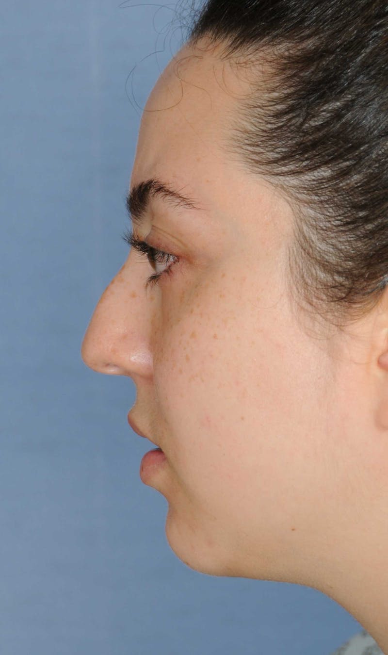 Rhinoplasty Before & After Gallery - Patient 309594 - Image 9