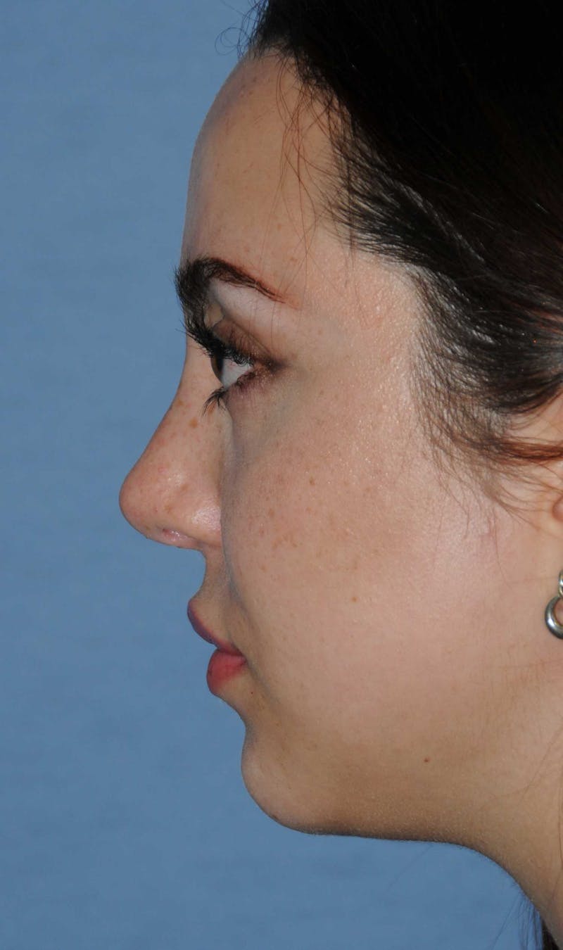 Rhinoplasty Before & After Gallery - Patient 309594 - Image 10