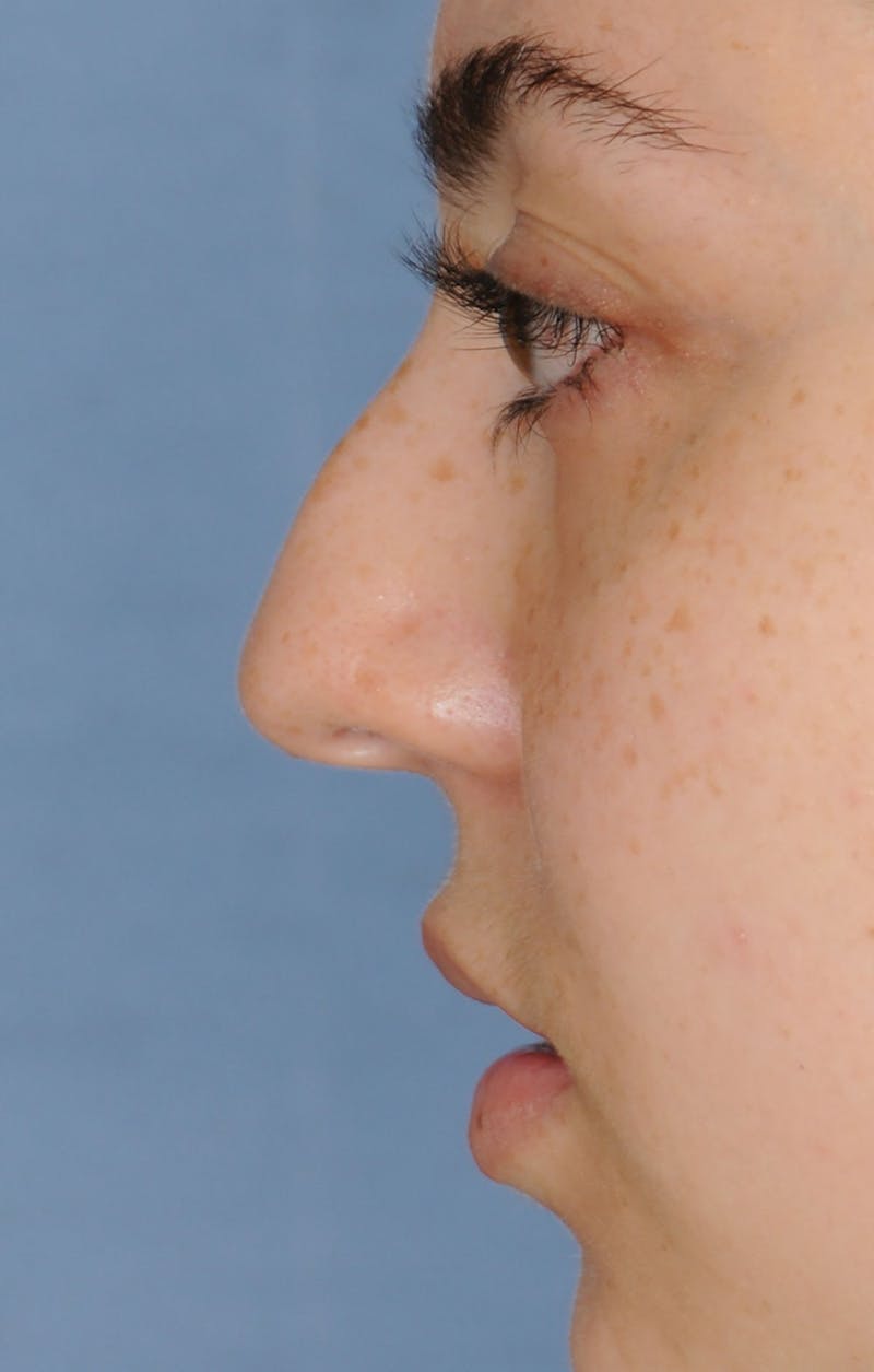Rhinoplasty Before & After Gallery - Patient 309594 - Image 11