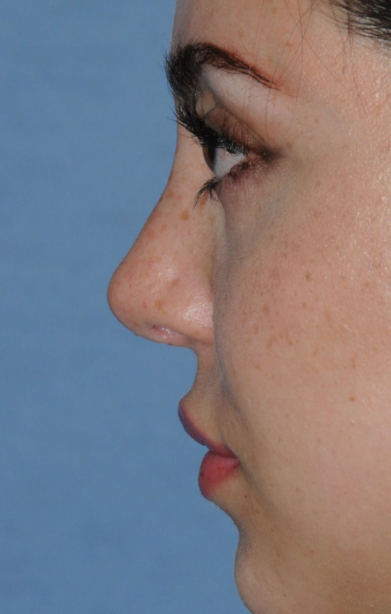 Rhinoplasty Before & After Gallery - Patient 309594 - Image 12