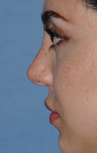 Rhinoplasty Before & After Gallery - Patient 309594 - Image 12