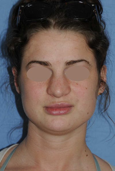 Rhinoplasty Before & After Gallery - Patient 668862 - Image 1