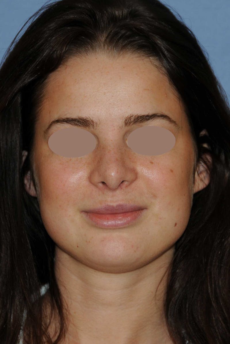 Rhinoplasty Before & After Gallery - Patient 668862 - Image 2