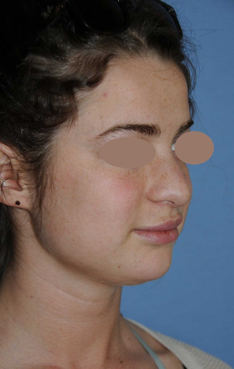 Rhinoplasty Before & After Gallery - Patient 668862 - Image 3