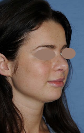Rhinoplasty Before & After Gallery - Patient 668862 - Image 4