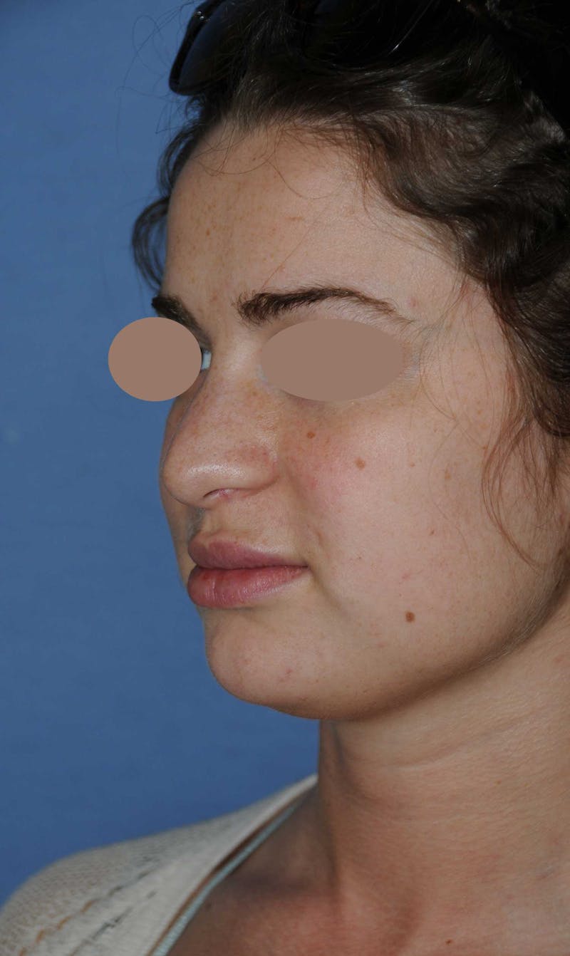 Rhinoplasty Before & After Gallery - Patient 668862 - Image 5