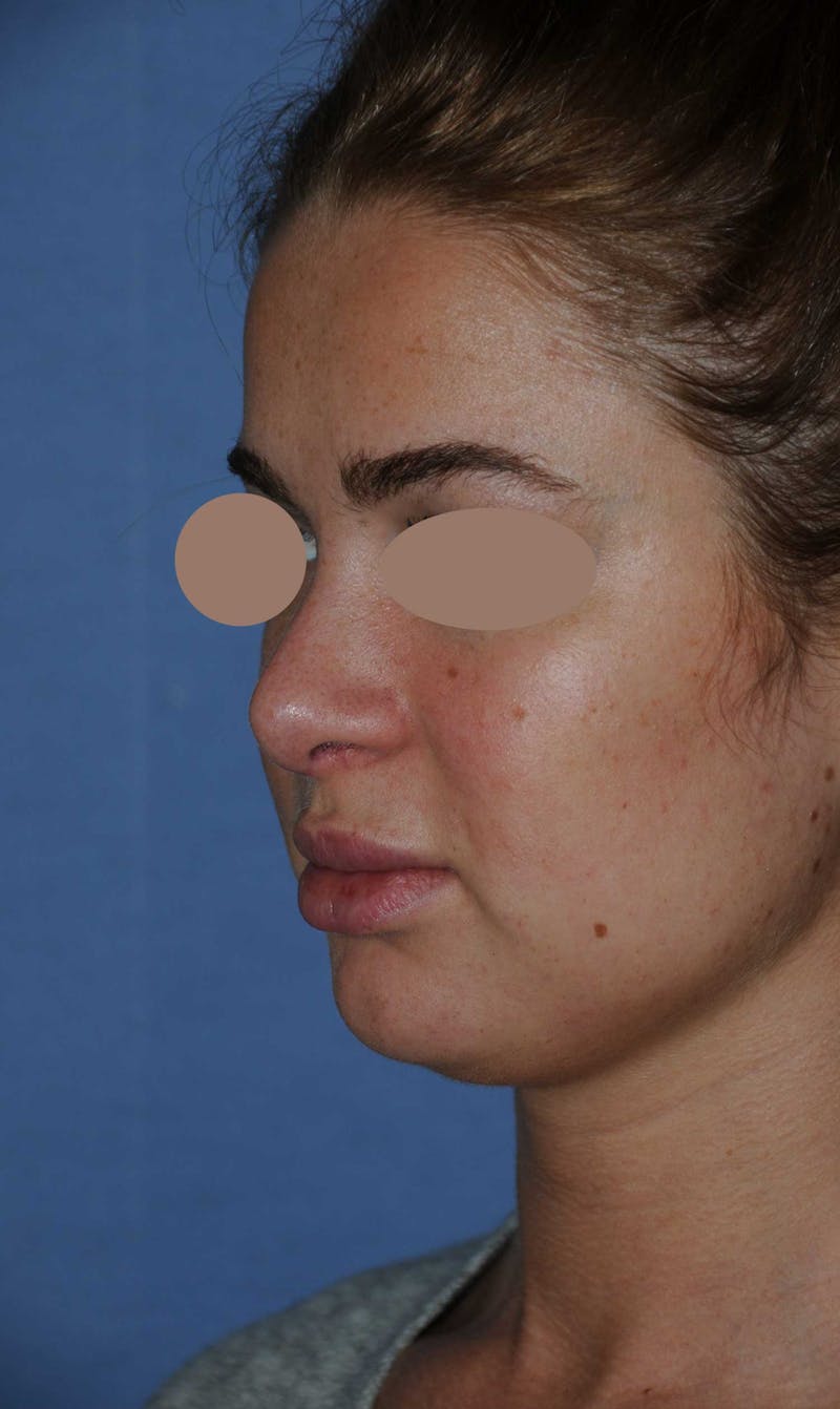 Rhinoplasty Before & After Gallery - Patient 668862 - Image 6