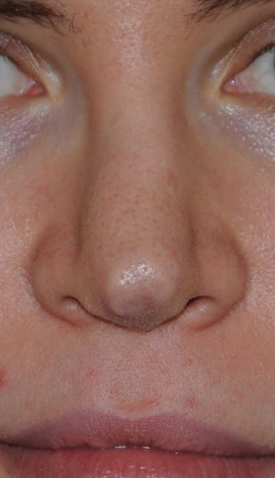 Rhinoplasty Before & After Gallery - Patient 395212 - Image 1
