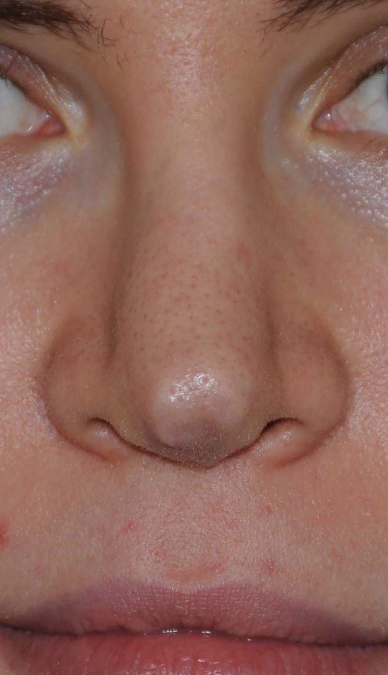 Rhinoplasty Before & After Gallery - Patient 395212 - Image 1