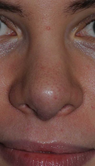 Rhinoplasty Before & After Gallery - Patient 395212 - Image 2