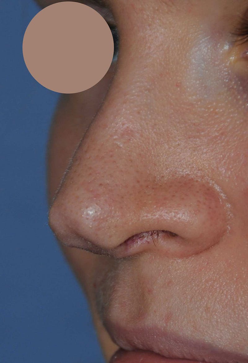Rhinoplasty Before & After Gallery - Patient 395212 - Image 3