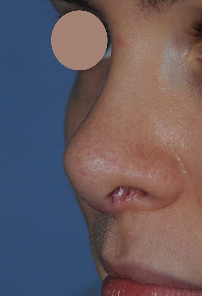 Rhinoplasty Before & After Gallery - Patient 395212 - Image 4