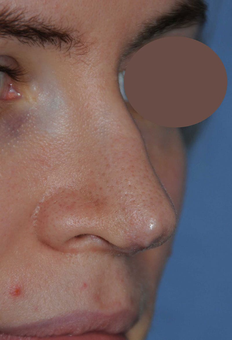 Rhinoplasty Before & After Gallery - Patient 395212 - Image 5