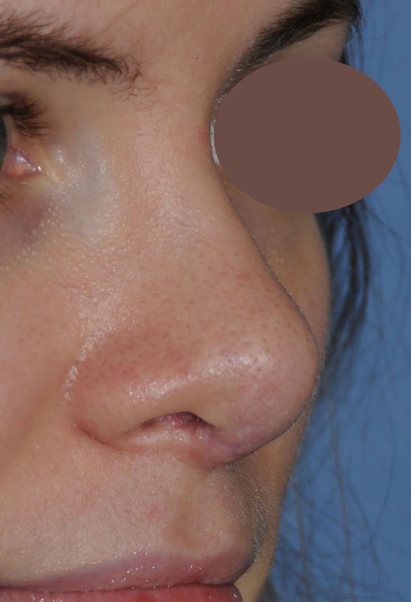 Rhinoplasty Before & After Gallery - Patient 395212 - Image 6