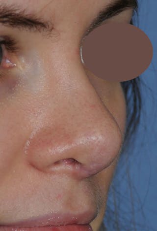 Rhinoplasty Before & After Gallery - Patient 395212 - Image 6