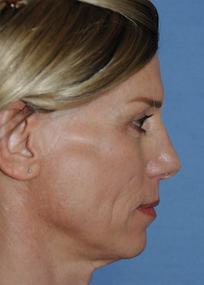 Rhinoplasty Before & After Gallery - Patient 186294 - Image 1