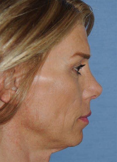 Rhinoplasty Before & After Gallery - Patient 186294 - Image 2