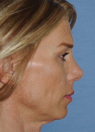 Rhinoplasty Before & After Gallery - Patient 186294 - Image 2