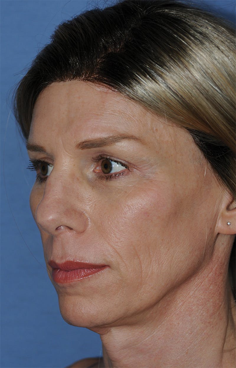 Transgender Surgery Before & After Gallery - Patient 897232 - Image 3