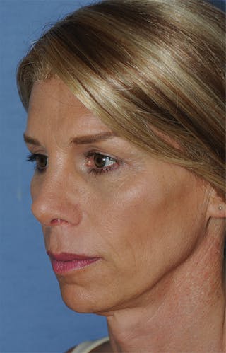 Rhinoplasty Before & After Gallery - Patient 186294 - Image 4