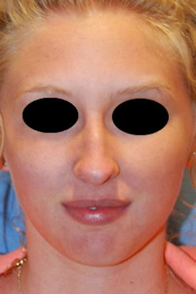 Rhinoplasty Before & After Gallery - Patient 736224 - Image 1