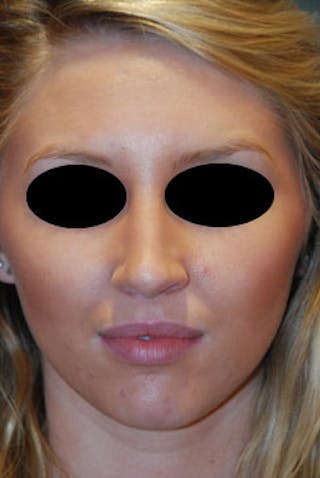 Rhinoplasty Before & After Gallery - Patient 736224 - Image 2