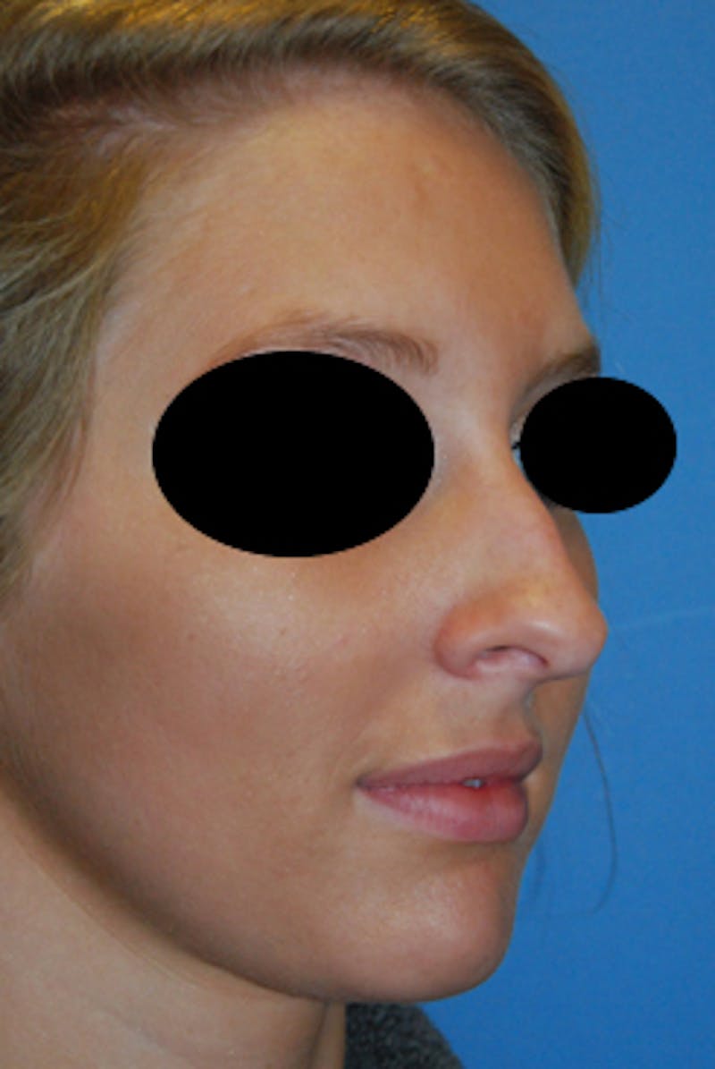 Rhinoplasty Before & After Gallery - Patient 736224 - Image 3