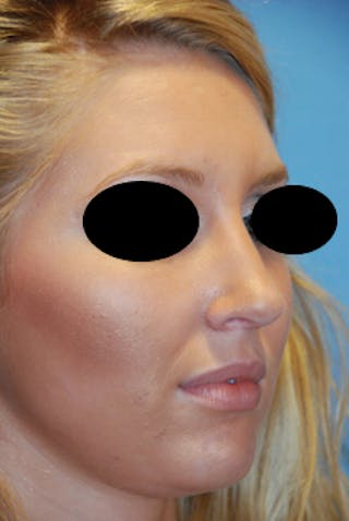 Rhinoplasty Before & After Gallery - Patient 736224 - Image 4