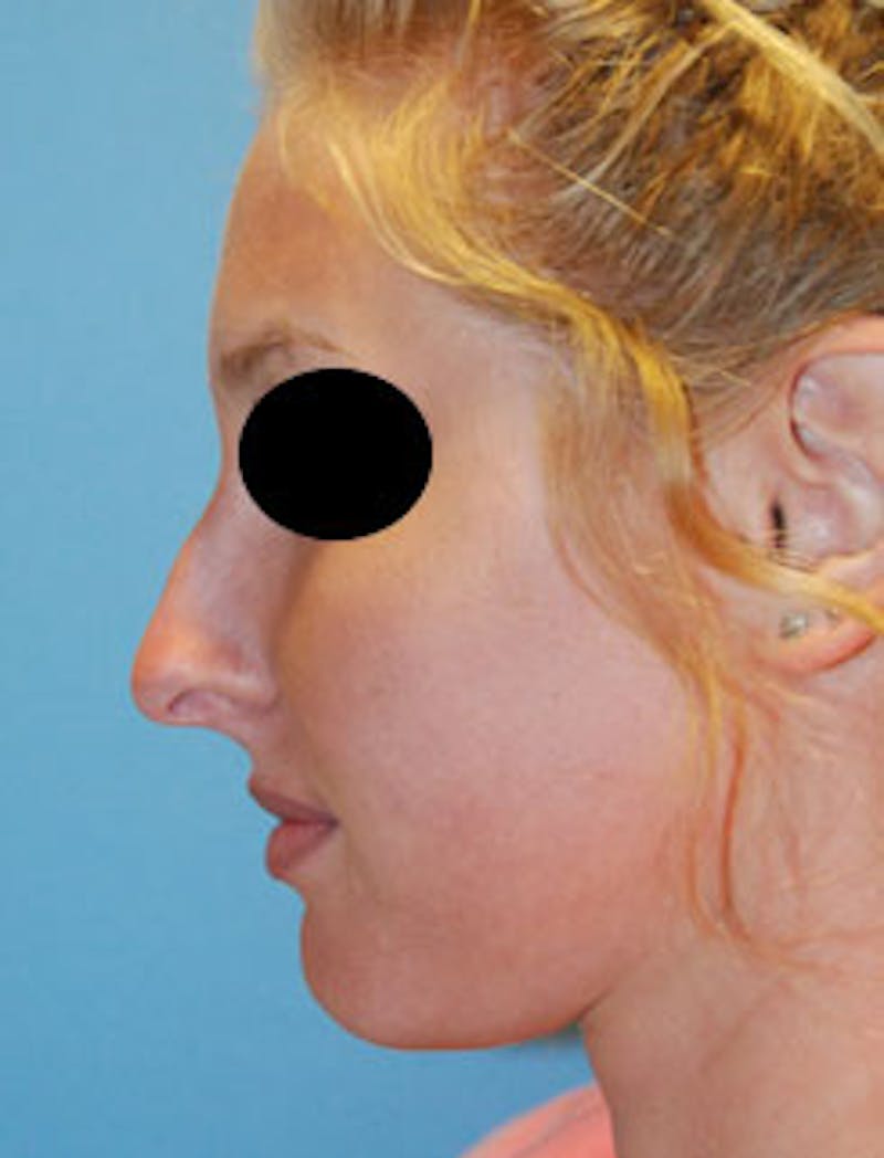 Rhinoplasty Before & After Gallery - Patient 736224 - Image 5