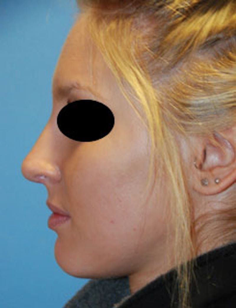 Rhinoplasty Before & After Gallery - Patient 736224 - Image 6