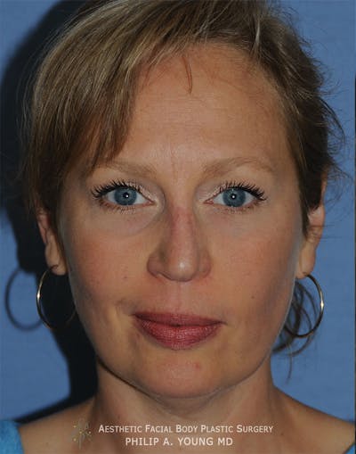 Rhinoplasty Before & After Gallery - Patient 400334 - Image 1