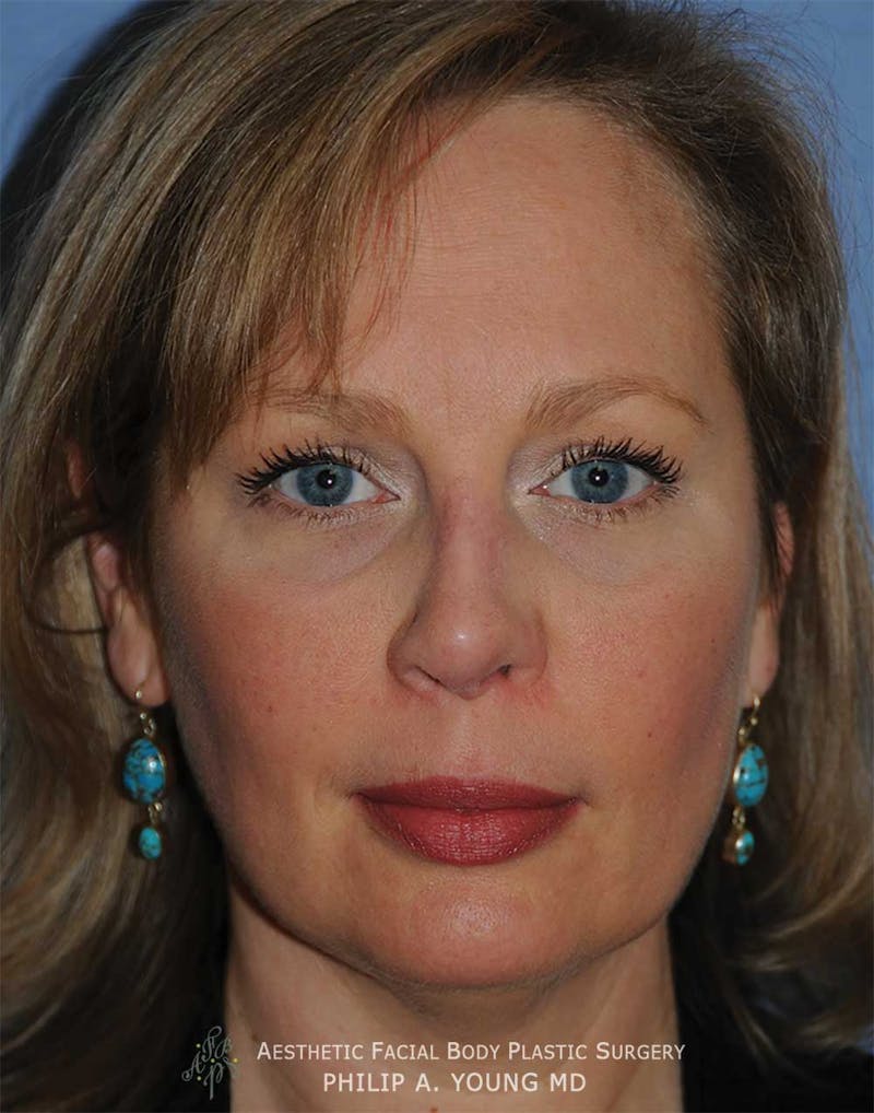 Rhinoplasty Before & After Gallery - Patient 400334 - Image 2