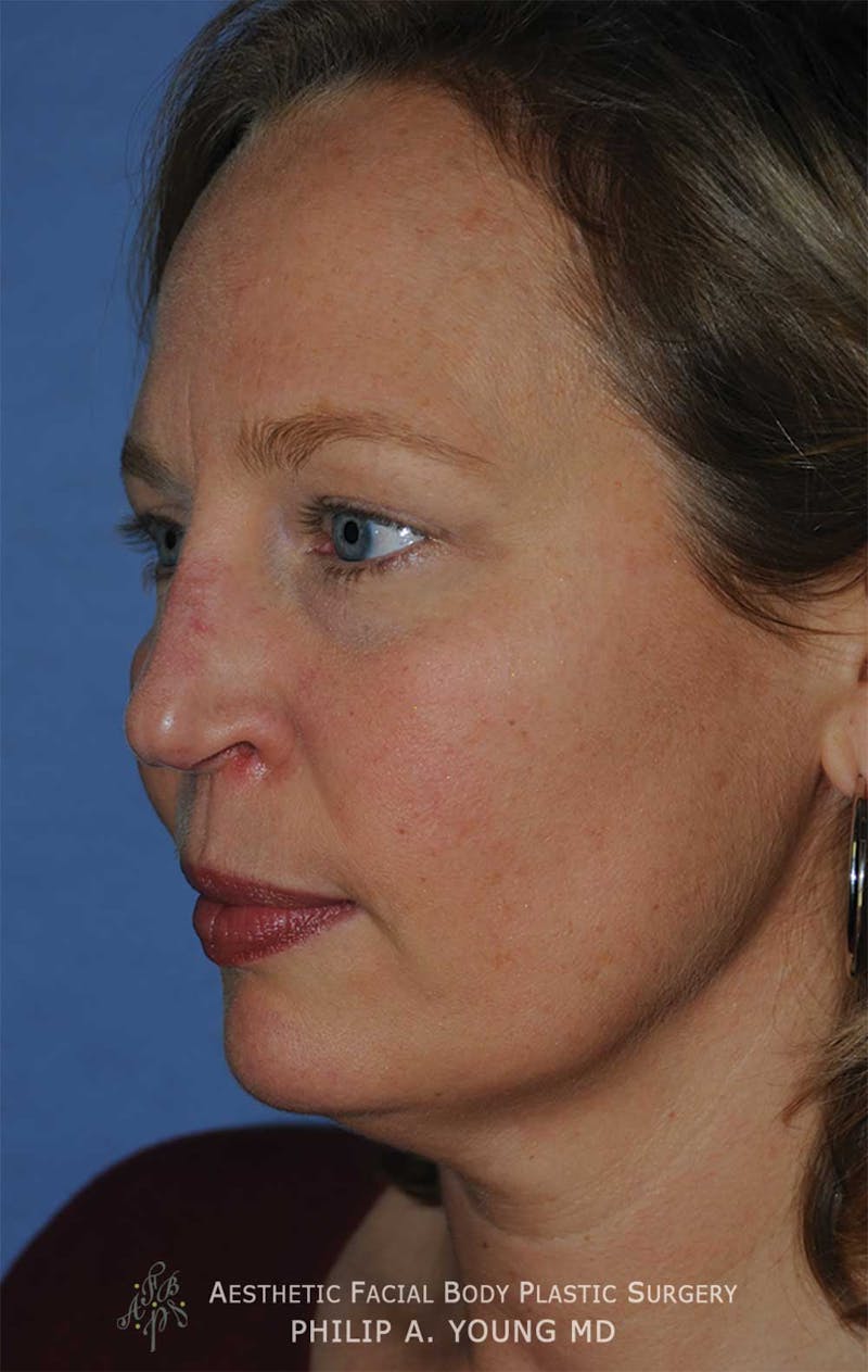 Rhinoplasty Before & After Gallery - Patient 400334 - Image 3