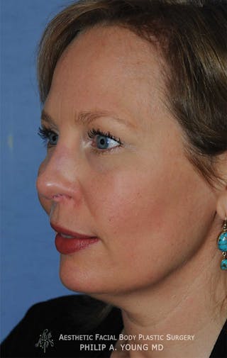 Rhinoplasty Before & After Gallery - Patient 400334 - Image 4