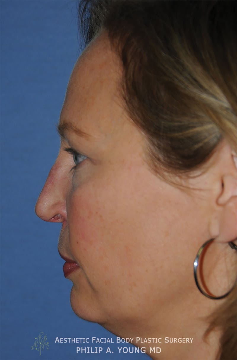 Rhinoplasty Before & After Gallery - Patient 400334 - Image 5