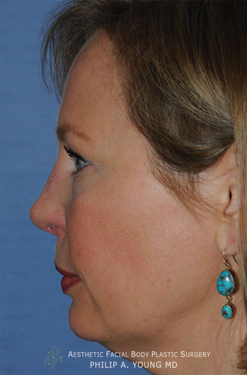 Rhinoplasty Before & After Gallery - Patient 400334 - Image 6