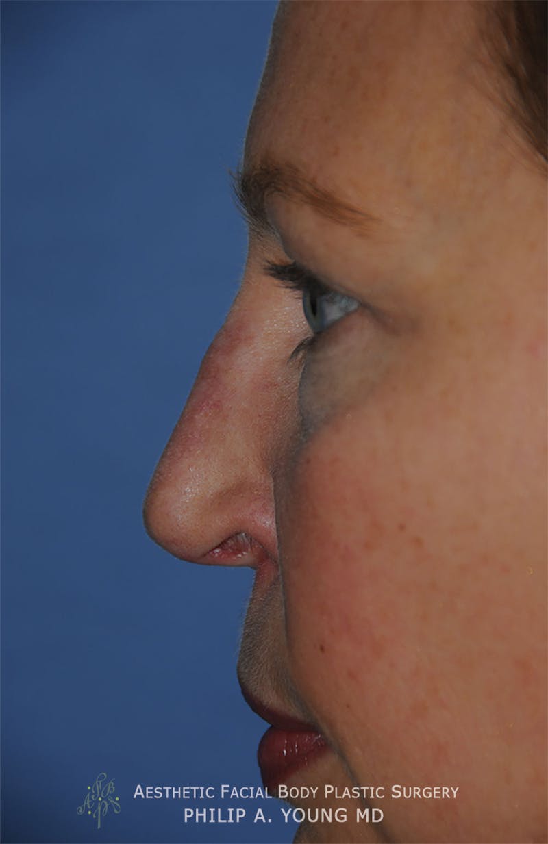 Rhinoplasty Before & After Gallery - Patient 400334 - Image 7