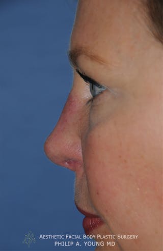 Rhinoplasty Before & After Gallery - Patient 400334 - Image 8