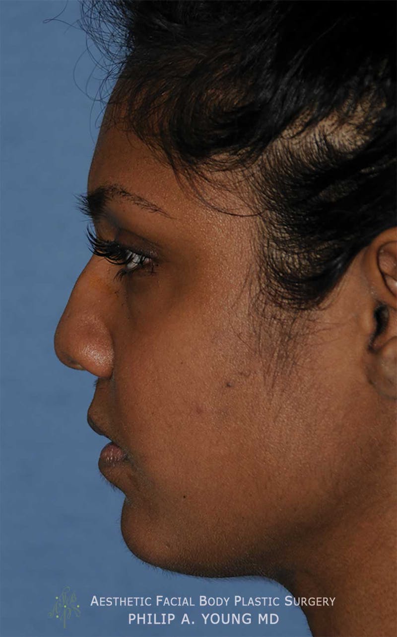 Rhinoplasty Before & After Gallery - Patient 364024 - Image 1