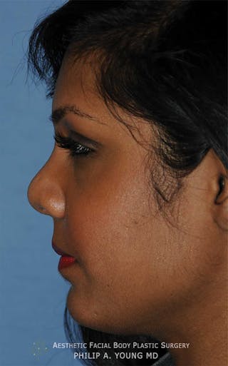Rhinoplasty Before & After Gallery - Patient 364024 - Image 2