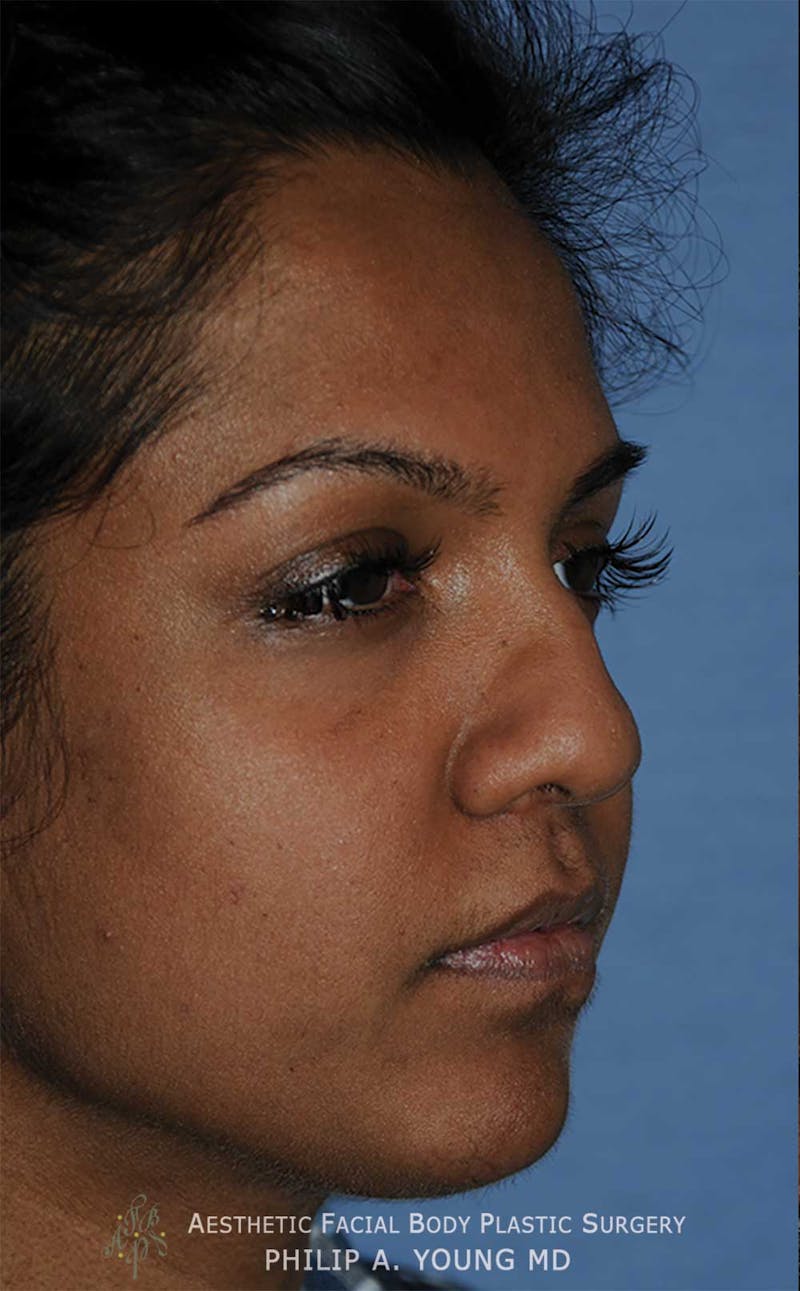 Rhinoplasty Before & After Gallery - Patient 364024 - Image 3