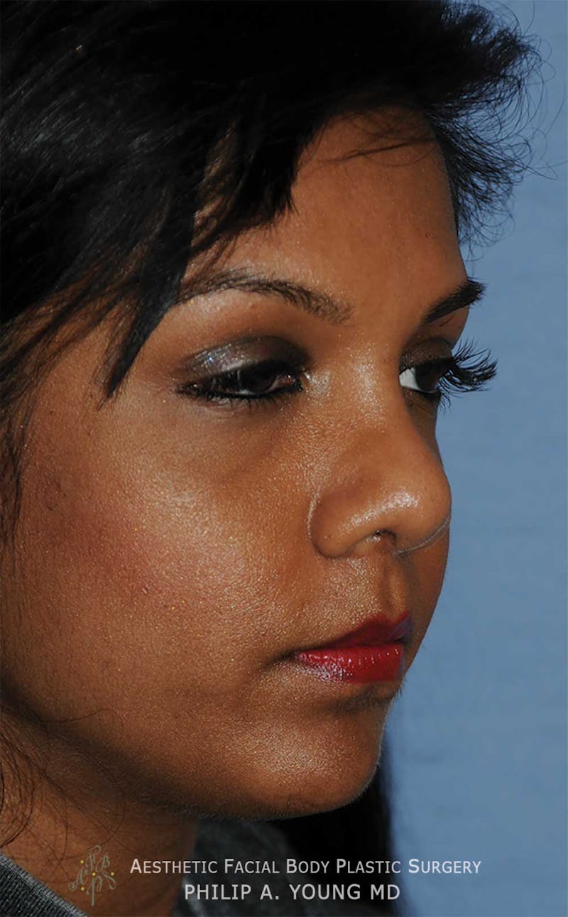 Rhinoplasty Before & After Gallery - Patient 364024 - Image 4