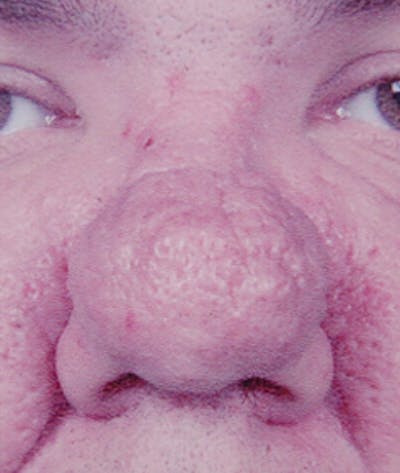 Rhinoplasty Before & After Gallery - Patient 183318 - Image 1