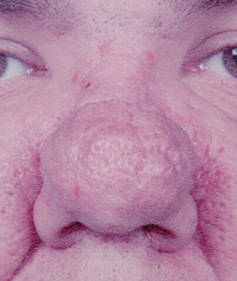 Rhinoplasty Before & After Gallery - Patient 183318 - Image 1