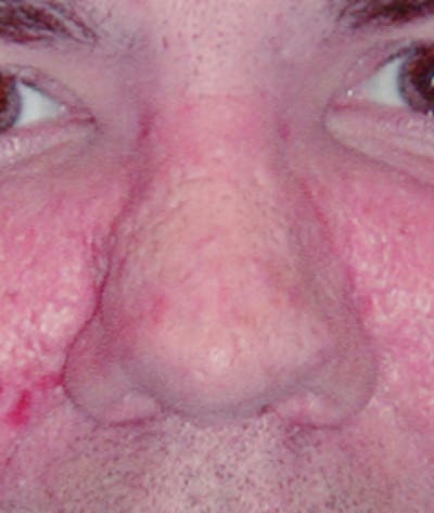 Rhinoplasty Before & After Gallery - Patient 183318 - Image 2