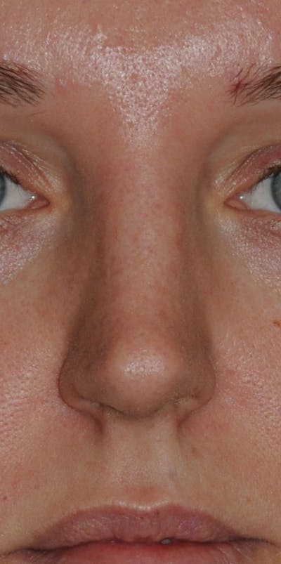 Rhinoplasty Before & After Gallery - Patient 452526 - Image 1