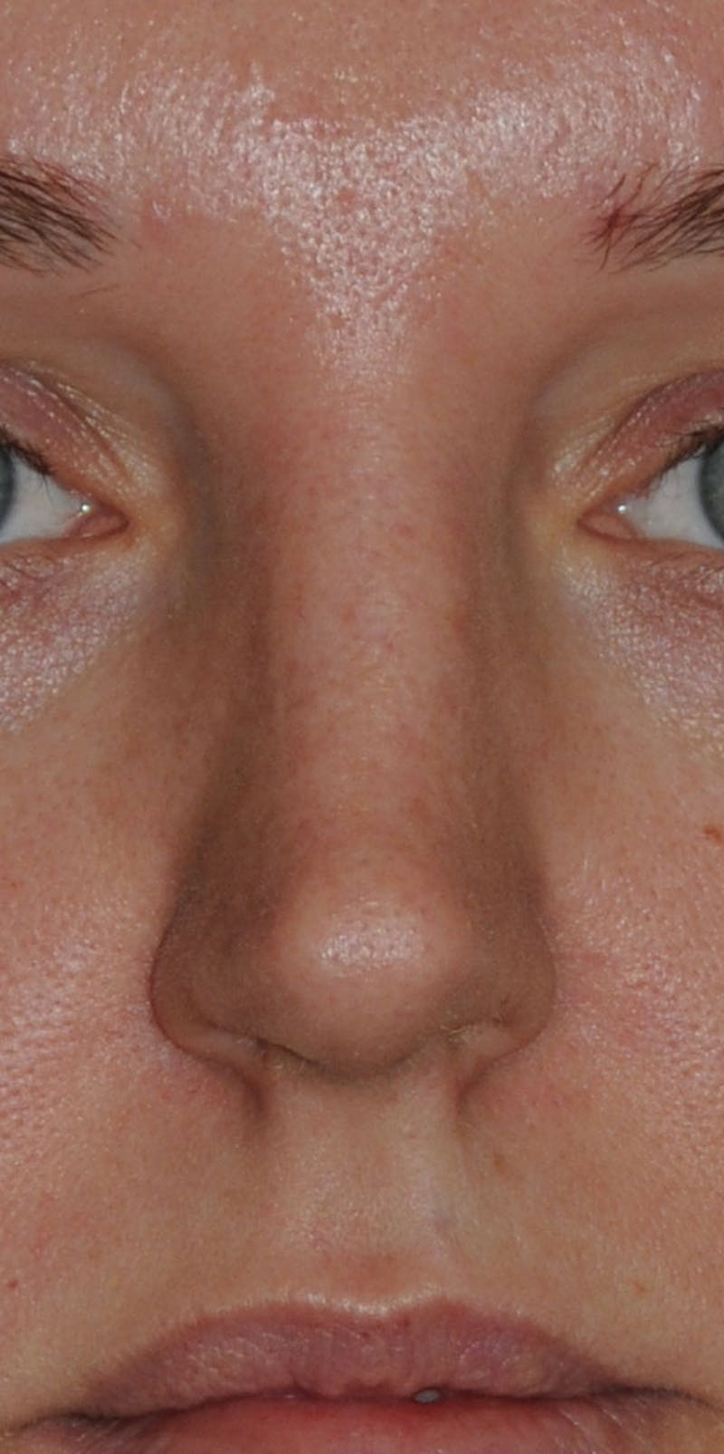 Rhinoplasty Before & After Gallery - Patient 452526 - Image 1