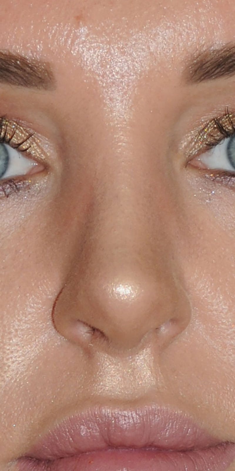 Rhinoplasty Before & After Gallery - Patient 452526 - Image 2