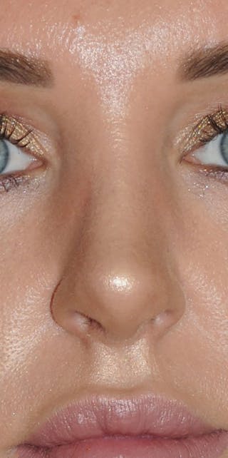 Rhinoplasty Before & After Gallery - Patient 452526 - Image 2